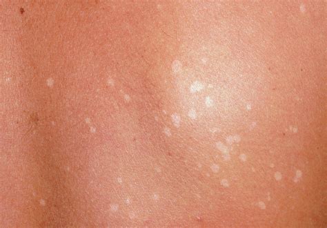 Pityriasis Versicolor Light Patches On Skin Photograph By Dr P