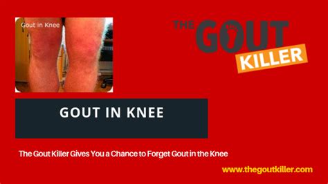 Pin On Gout In Knee