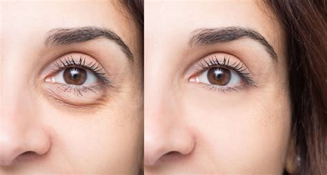 Top More Than Best Eye Bag Removal Treatment Best In Duhocakina