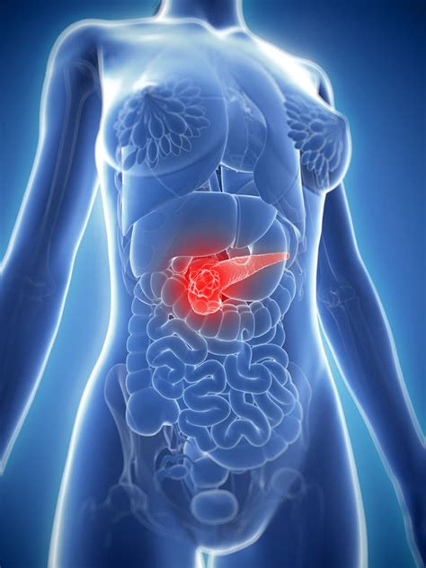 You may have experienced a number of different symptoms over the course of your disease. Pancreatic cancer symptoms: Back pain could be a sign of ...