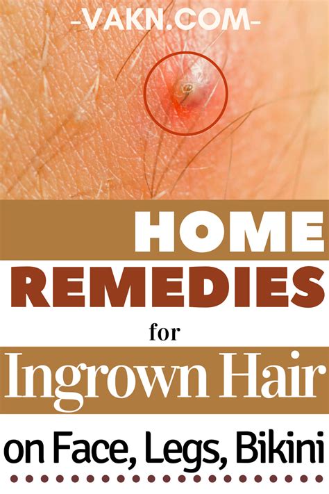 Home Remedies For Ingrown Hair On Face Legs Bikini Ingrown Hair