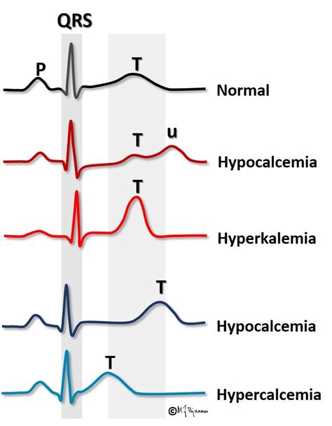 Hypokalemia Ecg