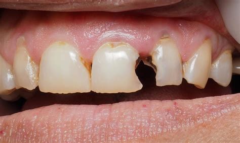 Hagan Dentistry Fixing Broken And Decayed Front Teeth