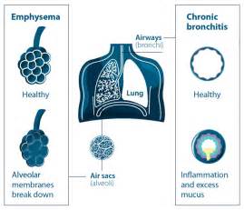 Know Your Disease Chronic Obstructive Pulmonary Disease Copd