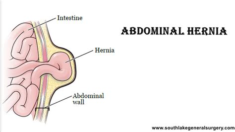 Abdominal Hernia Symptoms Diagnosis And Treatment Southlake Texas