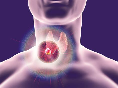 Thyroid Cancer What You Need To Know Penang Adventist Hospital
