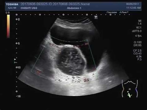 What Do Ovarian Cysts Look Like On Ultrasound