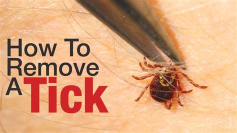 How To Remove A Tick From Your Leg Howtormeov