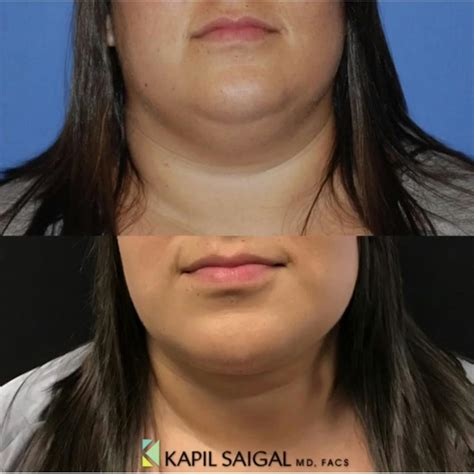 Patient 122446675 Facetite Before And After Photos Saigal Facial