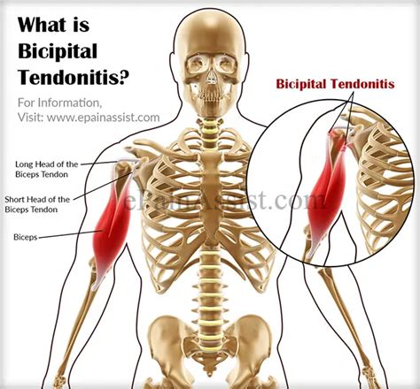 What Is Bicipital Tendonitiscausessymptomstreatmentexercises
