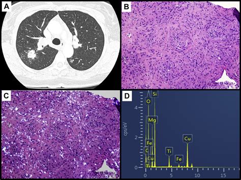 A 52 Year Old Woman With An Abdominal Mass Bilateral Pulmonary Nodules