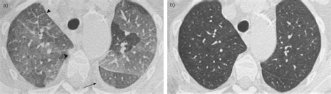Pulmonary Veno Occlusive Disease In Myeloproliferative Disorder