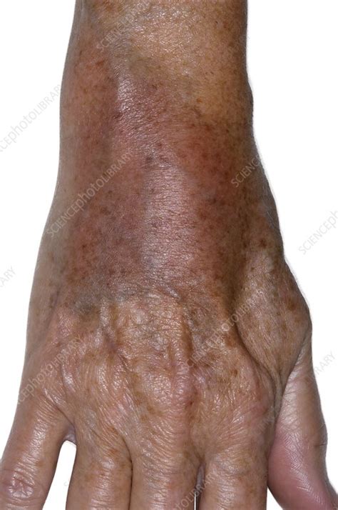 Bruised Wrist After A Fall Stock Image C0110439 Science Photo