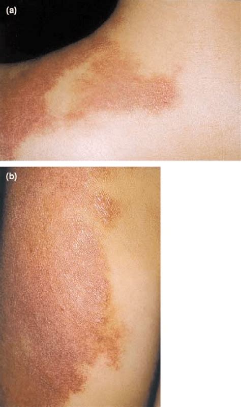 A Erythematous Scaly Lesions Confined Within The Borders Of The Pws