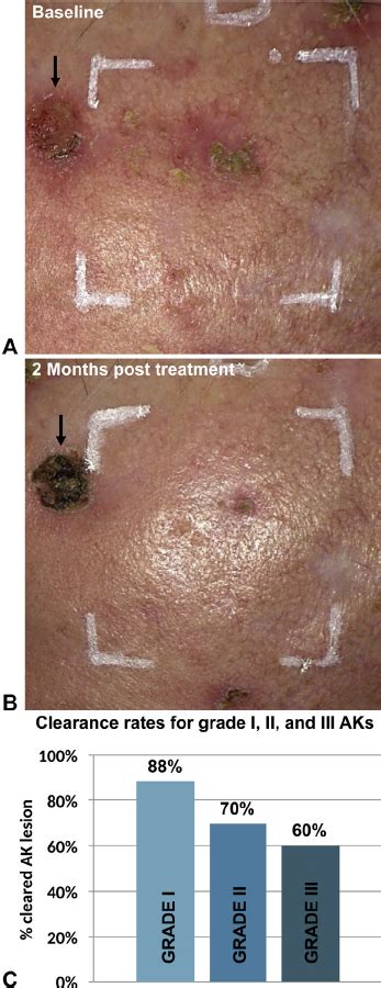 A And B Clearance Of Actinic Keratoses Ak After Ingenol Mebutate