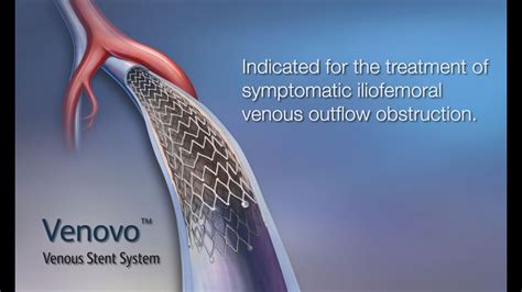 Bd Venovo Venous Stent Product Video Approved For Us Only Youtube