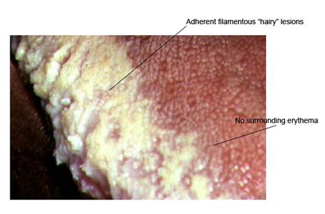 Or else under your tongue. Related Keywords & Suggestions for hairy leukoplakia tongue