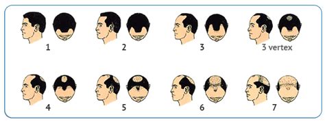 If you're wondering where you fall on the scale, schedule a free, private consultation with one of our hair loss experts. norwood-scale - HPC Scalp MicroPigmentation Center
