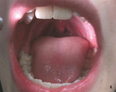 Girl Uvula Mouth Telegraph