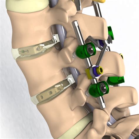 Alecta Posterior Lumbar Interbody Fusion Cages Plif Tlif Alif