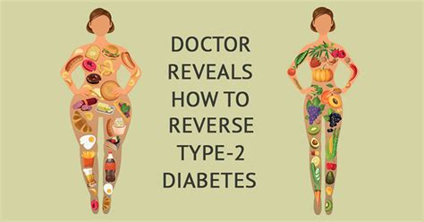Reversing Type 2 Diabetes Naturally - Diet, Exercise ...