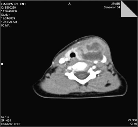 Ct Scan Showing A Hypodense Lesion Involving The Whole Of Left Thyroid