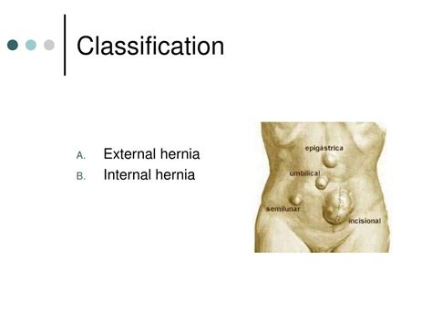 Ppt Hernias Powerpoint Presentation Id679255