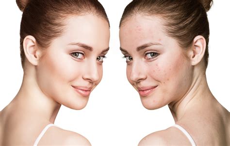 Girl With Acne Before And After Treatment Model In Clinic Aveiro