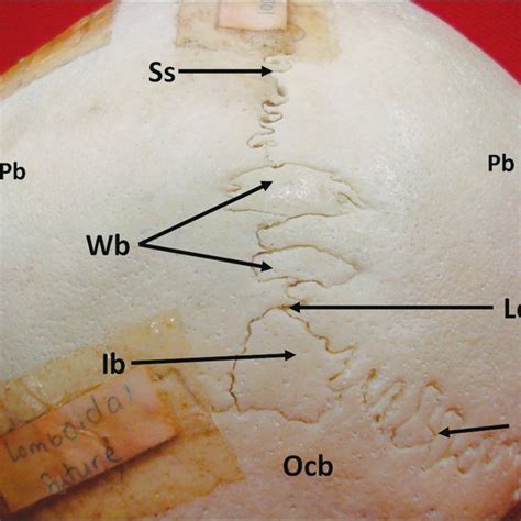 Superior View Of The Skull Cap Showing The Wormian Bones In The