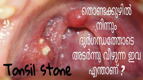 Tonsillitis Tonsilstone Home Remedies And Prevention Tonsilstone