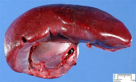 lymphoid organs - Humpath.com - Human pathology