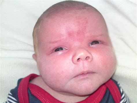 Maybe you would like to learn more about one of these? salmon patches birthmark - pictures, photos