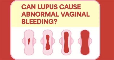 Can Lupus Cause Abnormal Vaginal Bleeding Mylupusteam