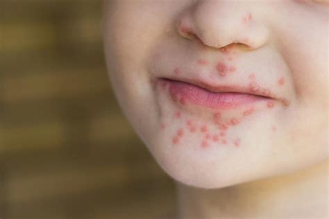 Viral Rash In Children Face