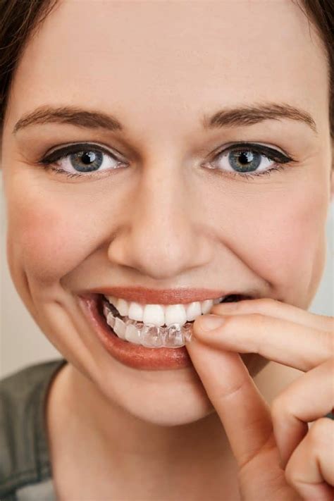 Invisalign Leeds Invisible Braces Clear Brace Dentists