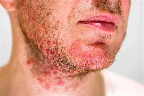 What An Hiv Rash Looks Like Types And Symptoms