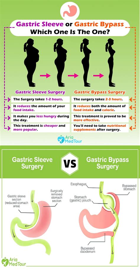 How Much Does Gastric Bypass Surgery Cost In Michigan
