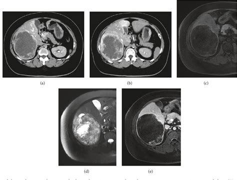 Figure 1 From Hepatic Sclerosing Hemangioma With Predominance Of The
