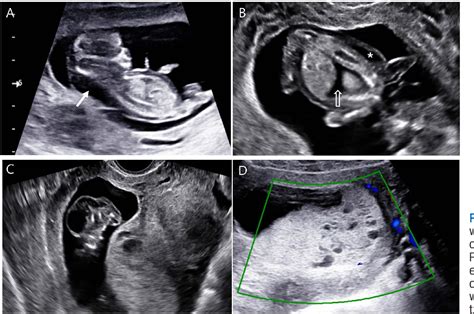 Figure 1 From Partial Molar Pregnancy And Coexisting Fetus With Turner