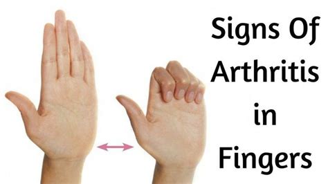 Early Signs Of Arthritis In Fingers Should Not Be Ignored