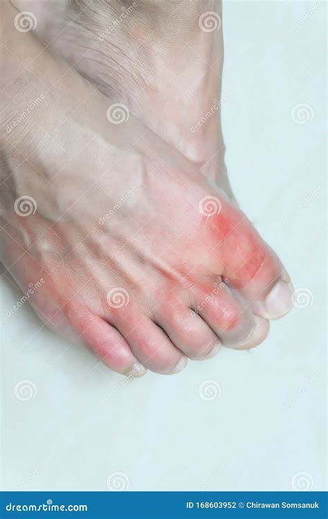 Man With Painful And Inflamed Gout On His Foot Around The Big Toe Area