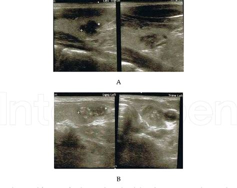 Figure 1 From Evaluation And Management Of Pediatric Thyroid Nodules