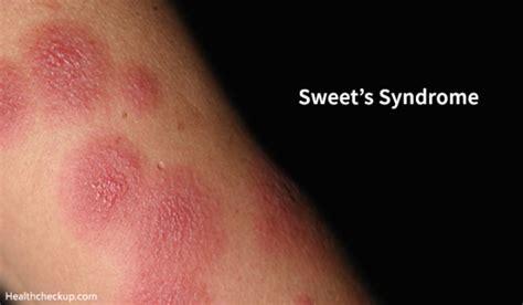 sweet s syndrome causes symptoms treatment complications
