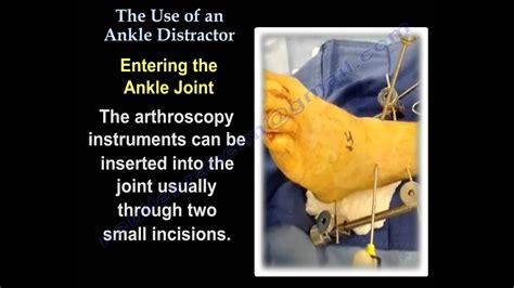 Ankle Arthroscopythe Use Of Ankle Distractor Everything You Need To