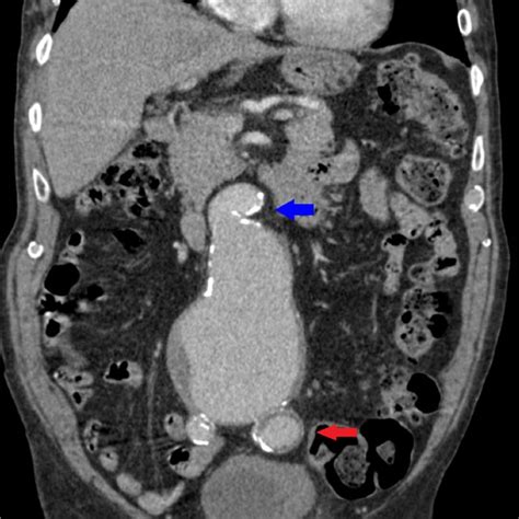 contrast enhanced axial ct of the abdomen and pelvis level of l4 download scientific diagram