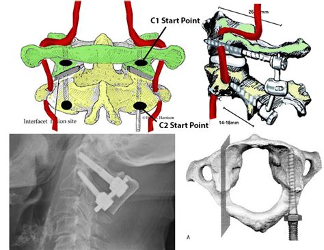 Odontoid Fracture Adult And Pediatric Spine Orthobullets