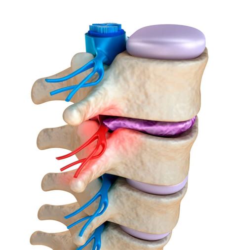 Pinched Nerve Symptoms And Treatments Minnesota Spine Institute