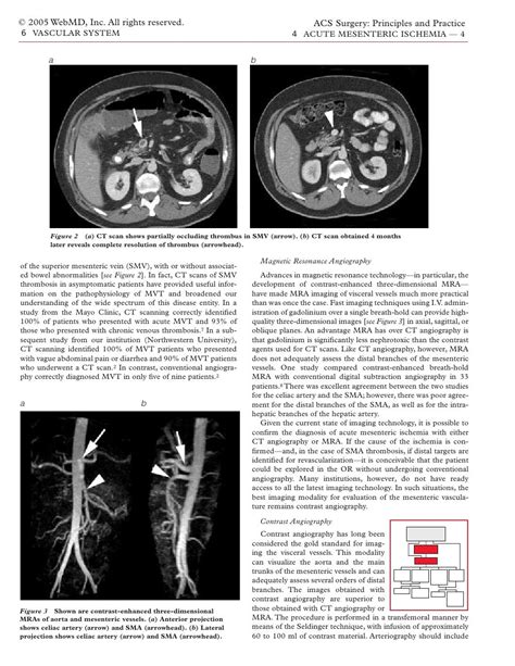 Acs0604 Acute Mesenteric Ischemia