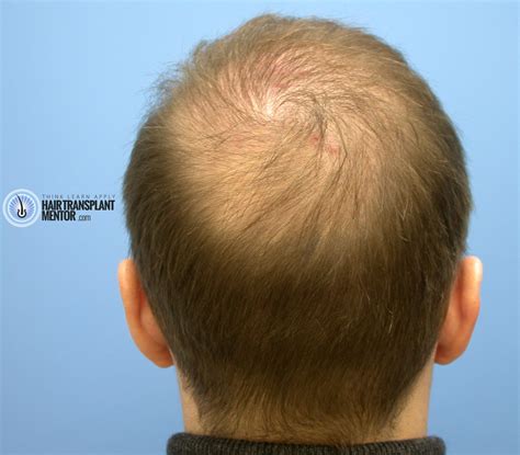 Hair Transplant 3 Month Results