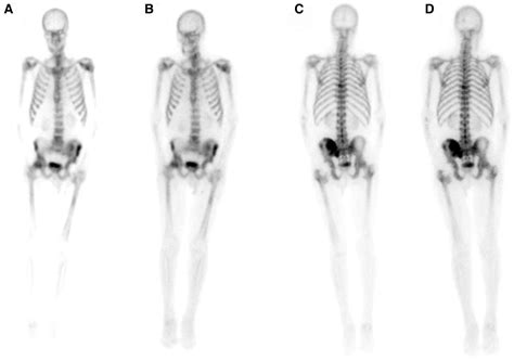 Can The Diagnostic Accuracy Of Bone Scintigraphy Be Maintained With